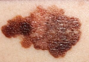 Cáncer de piel melanoma
